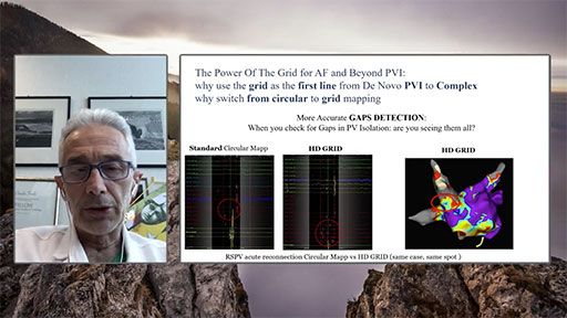 Prof Tondo shows his experience regarding the clinical benefits and procedural advantages of the usage of the HD Grid Mapping in Atrial Fibrillation