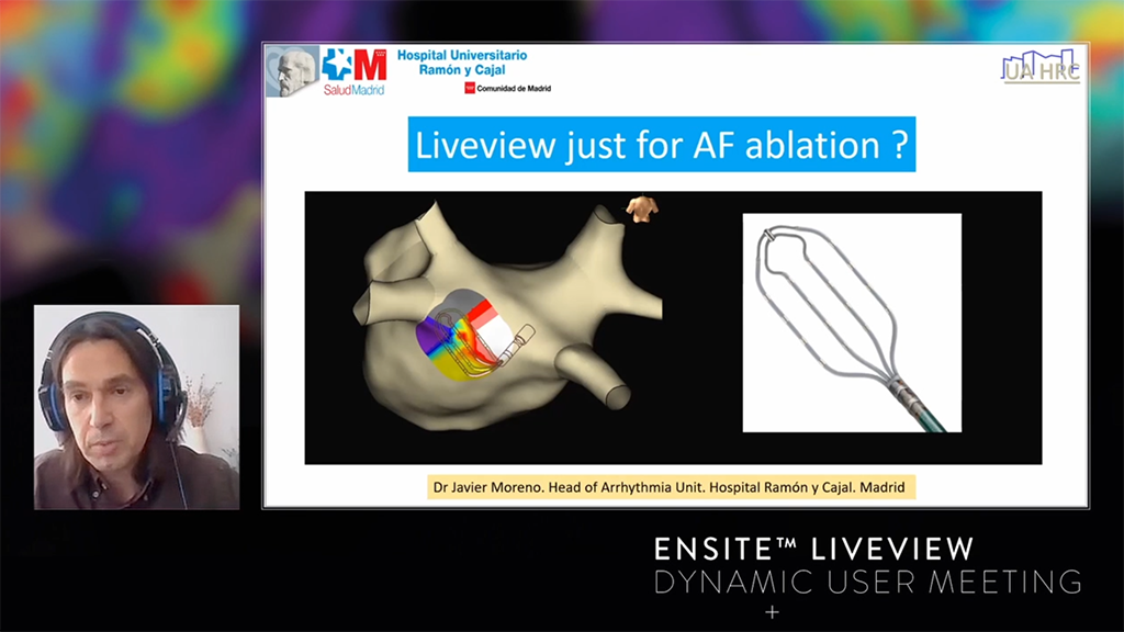 Live Dynamic Visualization of Wavefront and Arrhythmias Display