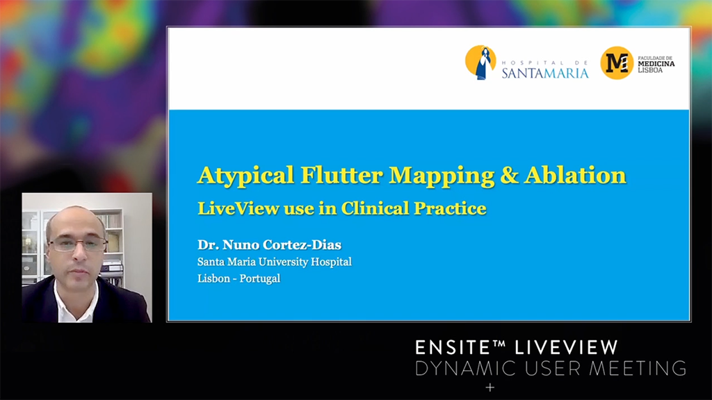 Left atrium AAFL combining the High Density Static Map with the new Live Dynamic Visualization