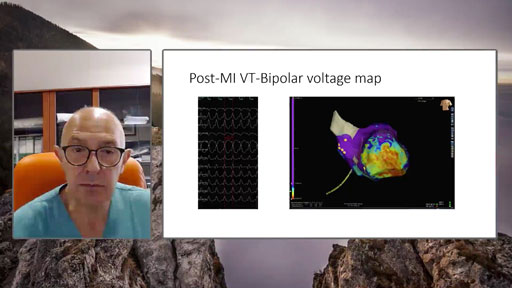Prof Tondo shows his experience regarding the clinical benefits and procedural advantages of the usage of the HD Grid Mapping in Atrial Fibrillation