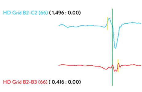 Two Advisor HD Grid Mapping Catheter, SE line graphs