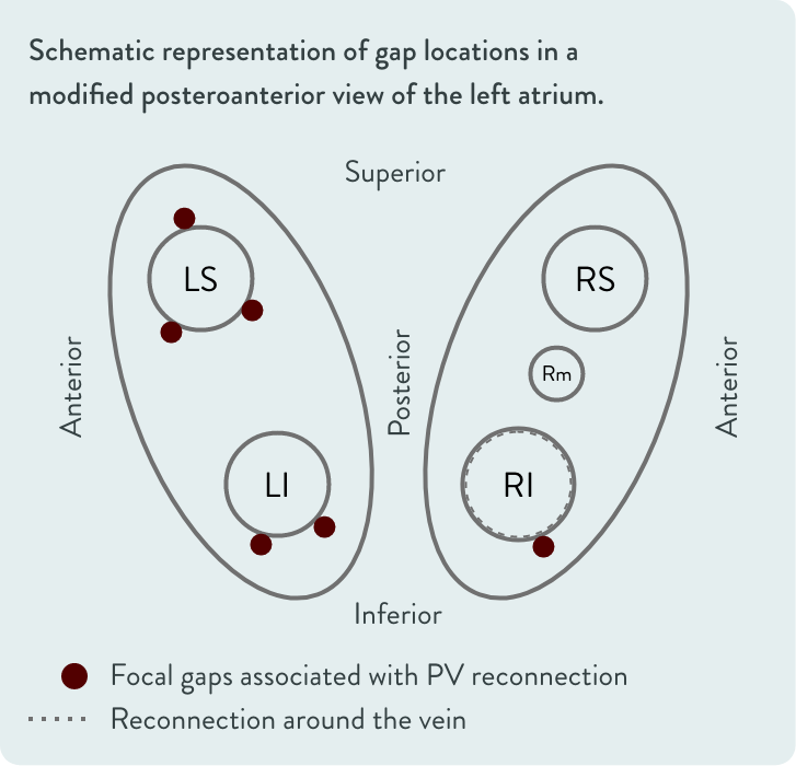 Schematic representation of gap locations 