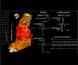 EnSite™ OT Near Field PF analysis of the fragmented potentials 