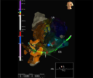 EnSite™ OT Near Field Peak omnipolar technology near ﬁeld for accessory pathway ablation through the coronary sinus