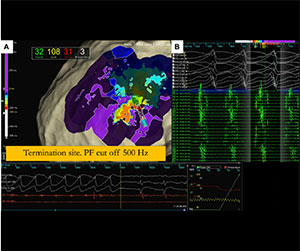 EnSite™ OT Near Field Analysis of electrogram peak frequency 