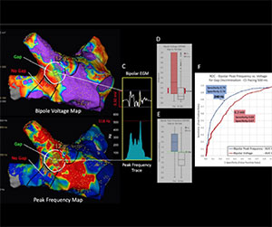 EnSite™ OT Near Field - far-ﬁeld versus near-ﬁeld frequencies at apparent versus true critical site