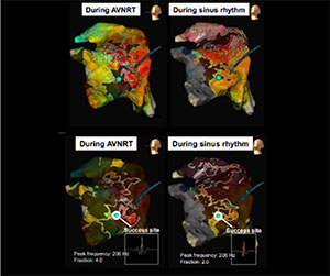 EnSite™ OT Near Field Peak novel near-ﬁeld detection algorithm