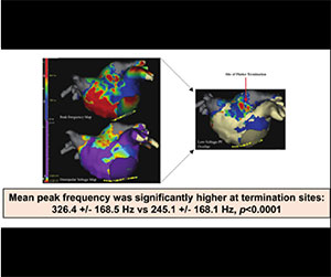 EnSite™ OT Near Field Peak frequency mapping of atypical atrial ﬂutter