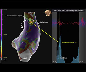 EnSite™ OT Near Field - Peak Frequency for Characterizing and Predicting Critical Isthmus