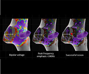 EnSite™ OT Near Field - Comparative utility of omnipolar and bipolar electroanatomic mapping method