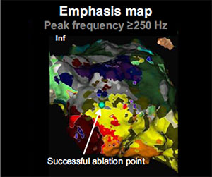 EnSite™ OT Near Field - Localized three dimensional reentrant ventricular tachycardia
