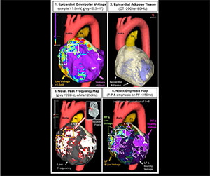 EnSite™ OT Near Field peak frequency analysis for epicardial contact mapping