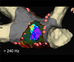 EnSite™ OT Near Field differentiation between epicardial and endocardial conduction gaps