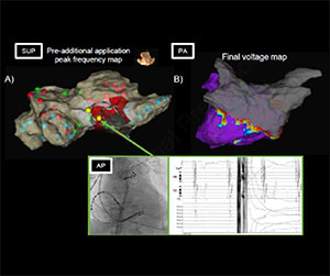 EnSite™ OT Near Field peak frequency-guided tissue proximity assessment