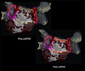EnSite™ OT Near Field Efficacy of the peak frequency map for left atrial posterior wall isolation