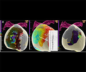 EnSite™ OT Near Field peak frequency mapping in Brugada Syndrome