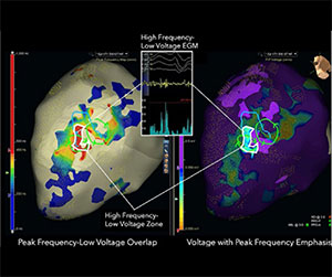 Peak frequency mapping to di4erentiate near-field from far-field electrograms