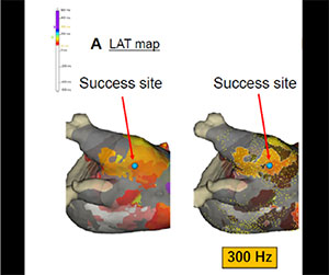 EnSite™ OT Near Field optimizing ablation sites for pulmonary vein isolation reconnections