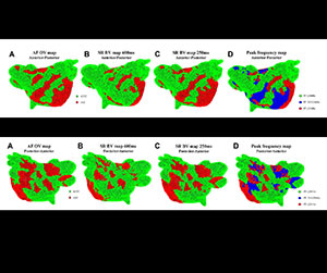 EnSite™ OT Near Field  - characterize scar in atrial ﬁbrillation