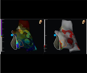 EnSite™ OT Near Field  - Identiﬁcation of the slow AV nodal pathway by low frequency mapping