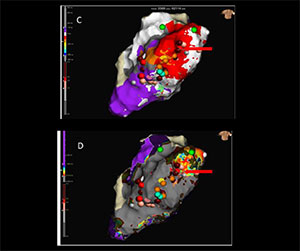 EnSite™ OT Near Field PF analysis of the fragmented potentials 