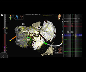 EnSite™ OT Near Field  - guided slow pathway ablation in typical atrioventricular nodal reentrant tachycardia