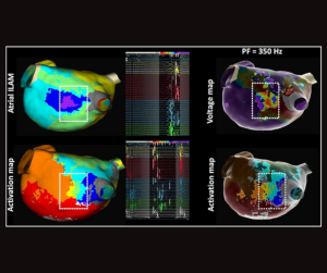 EnSite™ OT Near Field  - Peak frequency analysis and functional substrate mapping