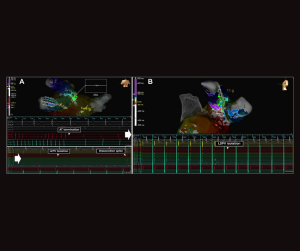 EnSite™ OT Near Field Peak -Visualizing the critical isthmus of complex atrial tachycardia