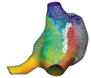 EnSite Omnipolar Technology: Right Atrial Map with HD Grid