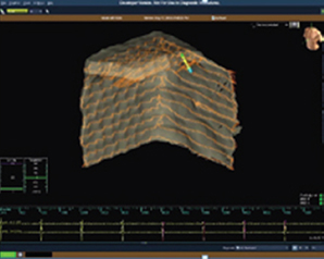 EnSite Precision display during DWL cube model creation.