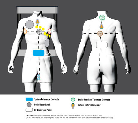 EnSite Precision Cardiac Mapping 電極情報を上に重ねた 2 つのヒトモデル。