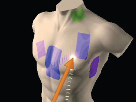 Human chest diagram depicting possible voltage gradients.