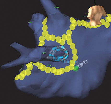 Human torso from the back with electrodes and motion displayed.