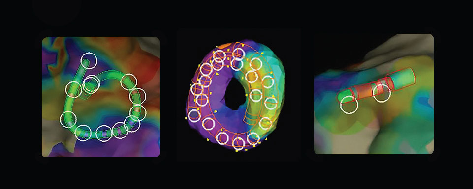 Three examples of EnSite Precision high density mapping.