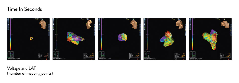 Five EnSite Precision maps showing time in seconds, voltage and LAT.