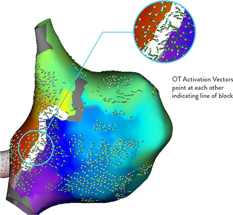 EnSite Electrogram