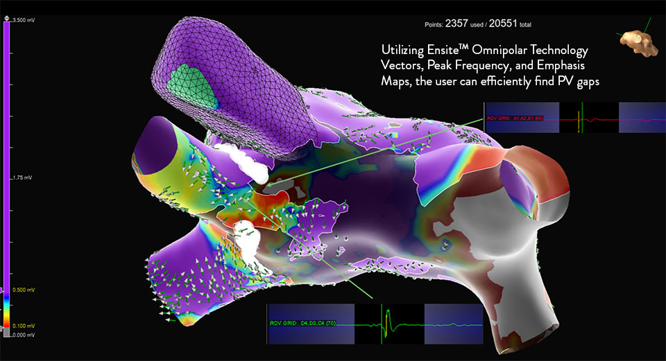 EnSite Omnipolar Techology vectors