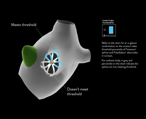 EnSite Contact Index Map