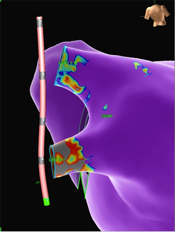 EnSite X EP System