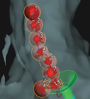 Herz-Mapping-Anzeige mit AutoMark-Platzierung des TactiCath™ Ablationskatheters mit Anpressdruckmessung, Sensor Enabled™.