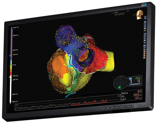 EnSite Cardiac Auto Map featuring contact force data from the TactiCath Contact Force Ablation Catheter, SE.