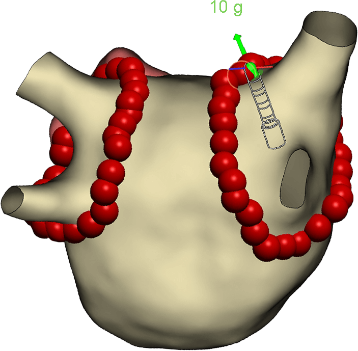    Lesion Creation