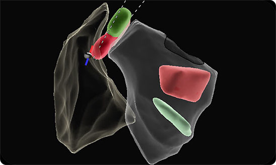 Electrophysiology EnSite X Echo Module