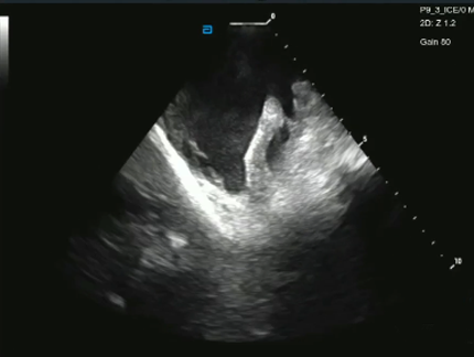 EnSite Echo Modules as viewed using the ViewFlex X ICE Catheter, SE