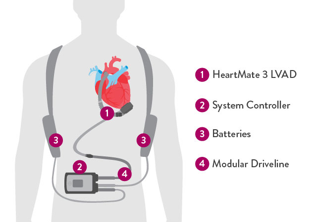  Silhouette of figure with HeartMate 3 LVAD and components overlaid on his figure.