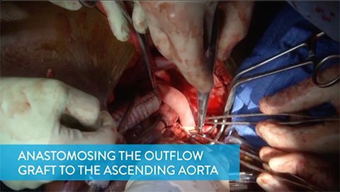 Anastomosing the Outflow Graft to the Ascending Aorta Video