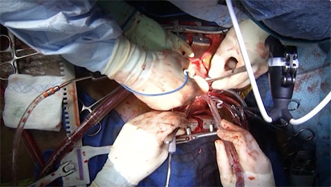 Anastomosing the Outflow Graft to the Ascending Aorta Video
