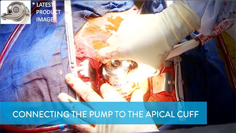 Connecting the Pump to the Apical Cuff