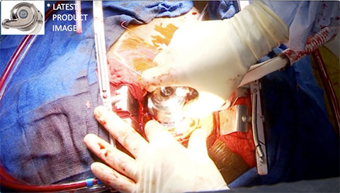 Connecting the Pump to the Apical Cuff