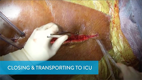 Closing & Transporting to ICU Video